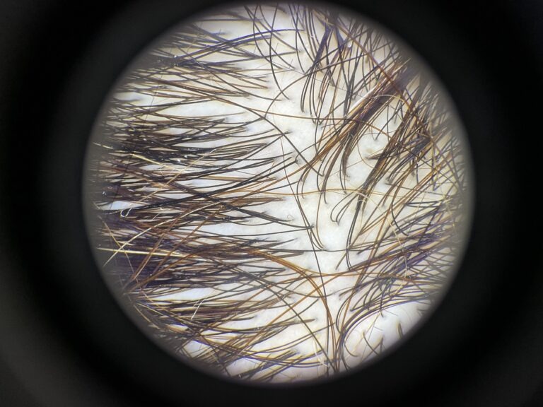 Tricoscopia — evaluación capilar con dermatoscopio