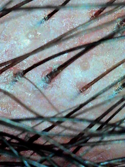 Tricoscopia — detalle de salida folicular