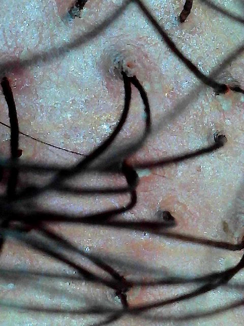 Tricoscopia — cuero cabelludo y tallos capilares